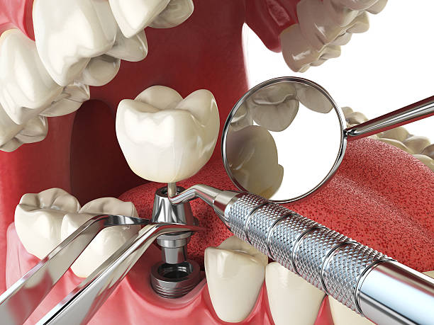 Best Emergency Root Canal Treatment in Vista Santa Rosa, CA